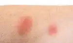 Fleabite (Pire Isırığı) Nedir?