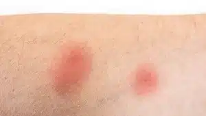 Fleabite (Pire Isırığı) Nedir?