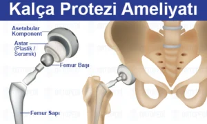 Kalça Protezi Ameliyatı Hakkında Bilmeniz Gerekenler