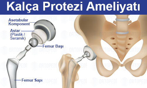 Kalça Protezi Ameliyatı Hakkında Bilmeniz Gerekenler