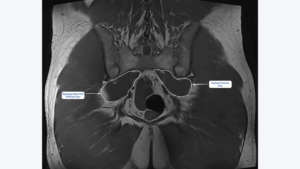 Piriformis Sendromu: Bel Fıtığı Sanılan İnce ama İnatçı Bir Ağrı Kaynağı