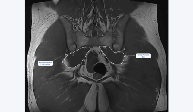 Piriformis Sendromu: Bel Fıtığı Sanılan İnce ama İnatçı Bir Ağrı Kaynağı