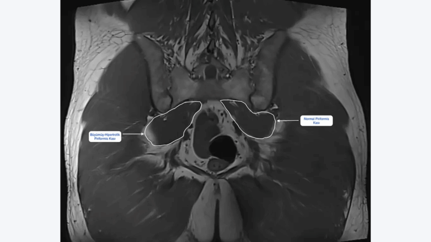 Piriformis Sendromu: Bel Fıtığı Sanılan İnce ama İnatçı Bir Ağrı Kaynağı
