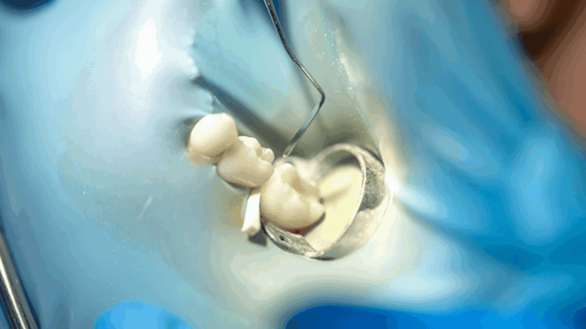 Dentoniks İle Bursa Kanal Tedavisi Sürecinde Ağrısız Tedavi Alın